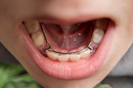 a child with a space maintainer in their mouth