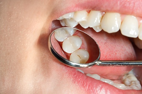 a dental mirror showing a child’s tooth with a cavity