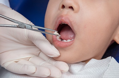 Closeup of smile during tooth extractions