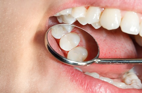 Closeup of healthy smile after tooth colored fillings