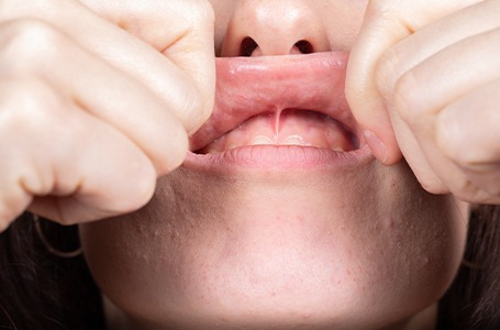 Patient performing stretches after frenectomy