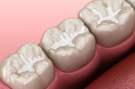 Dental sealants in Allen 