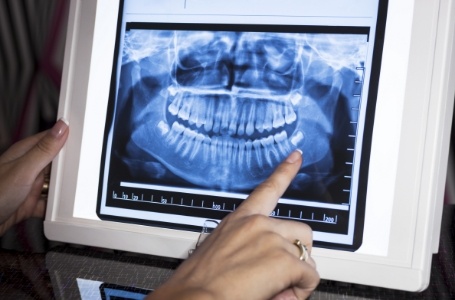 Digital dental x-rays